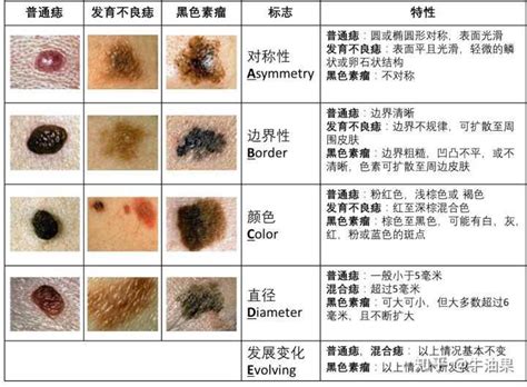 痣的顏色|痣是什麼？會變成黑色素瘤？7種一定要除的痣